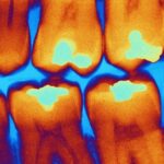Alimentos ultraprocesados estarían relacionados con enfermedades crónicas.